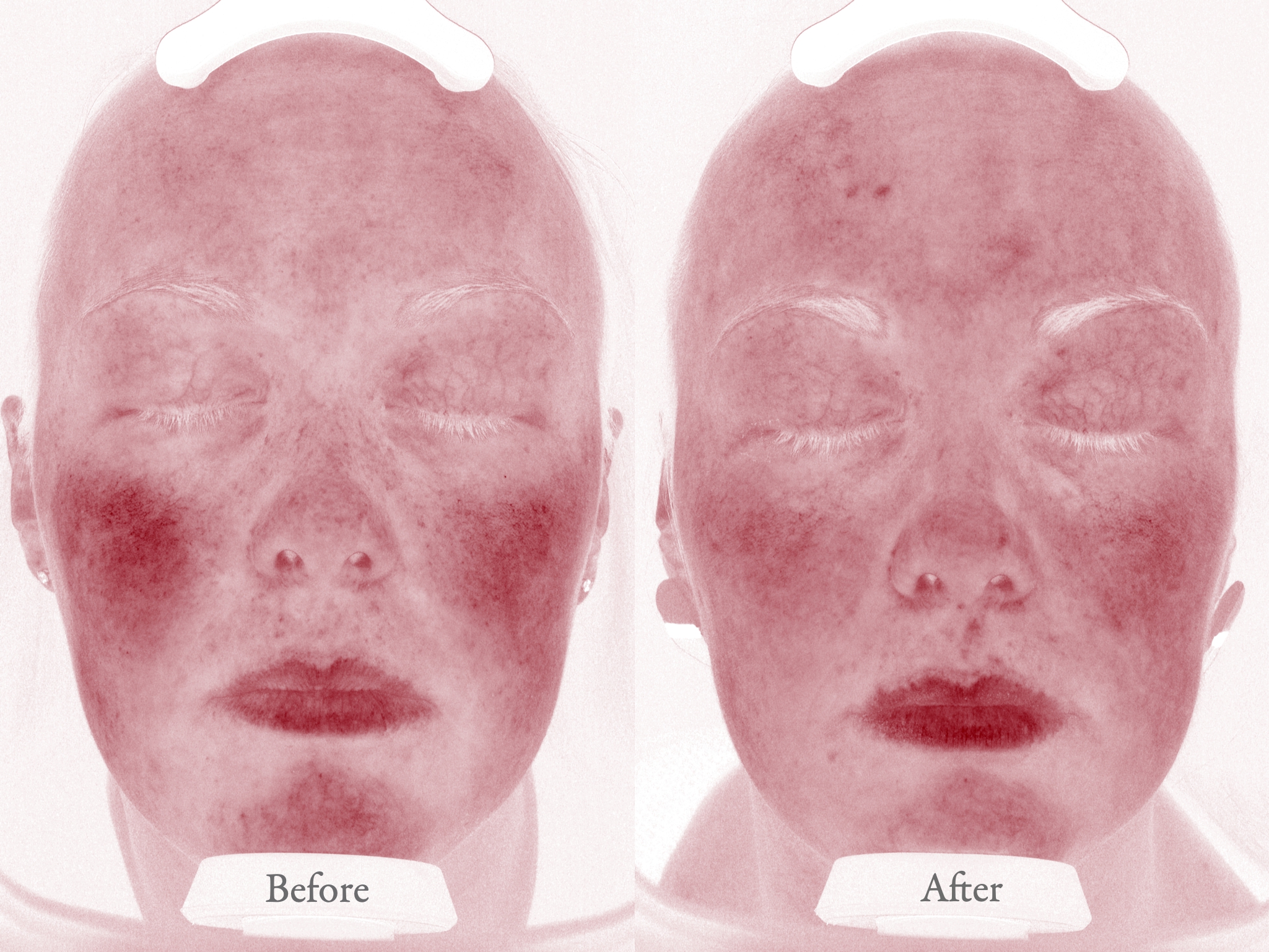 Results of BBL Treatment from Your Wellness Center in Cincinnati, Before and After